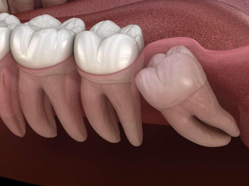 Wisdom Tooth Removal  Singapore