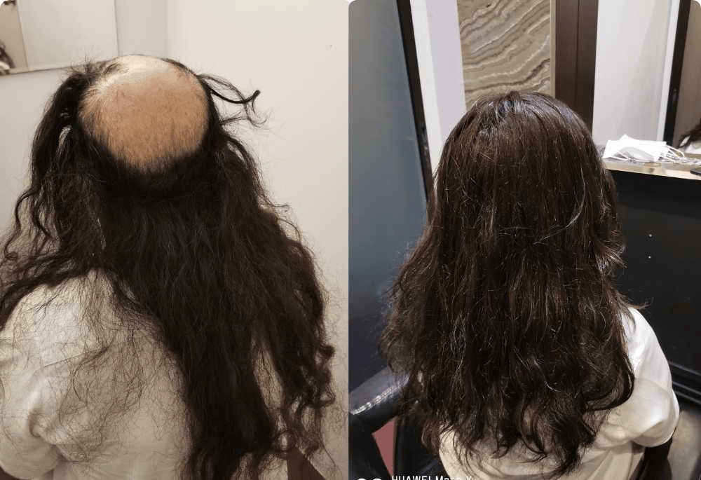 Hair Replacement  Singapore
